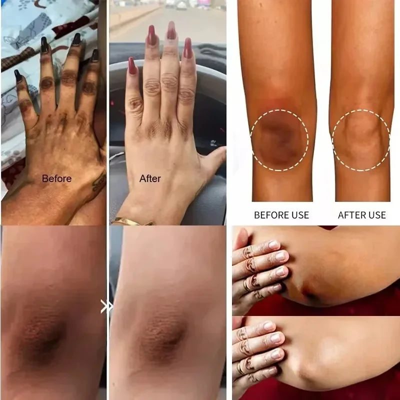 Feeling Embarrassed by Dark Spots? – Discover the Intimate Whitening Cream for Confidence & Radiant Skin