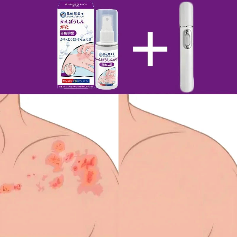 “Pain Relief Therapy Device – Fast & Safe Solution for Herpes & Shingles”
