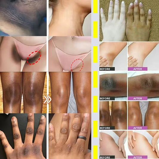 Feeling Embarrassed by Dark Spots? – Discover the Intimate Whitening Cream for Confidence & Radiant Skin